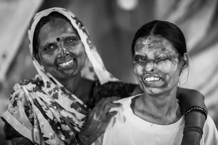 i-made-portraits-of-acid-attacks-survivors-in-india-4__880
